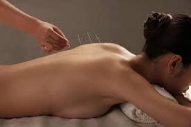 Acupuntura